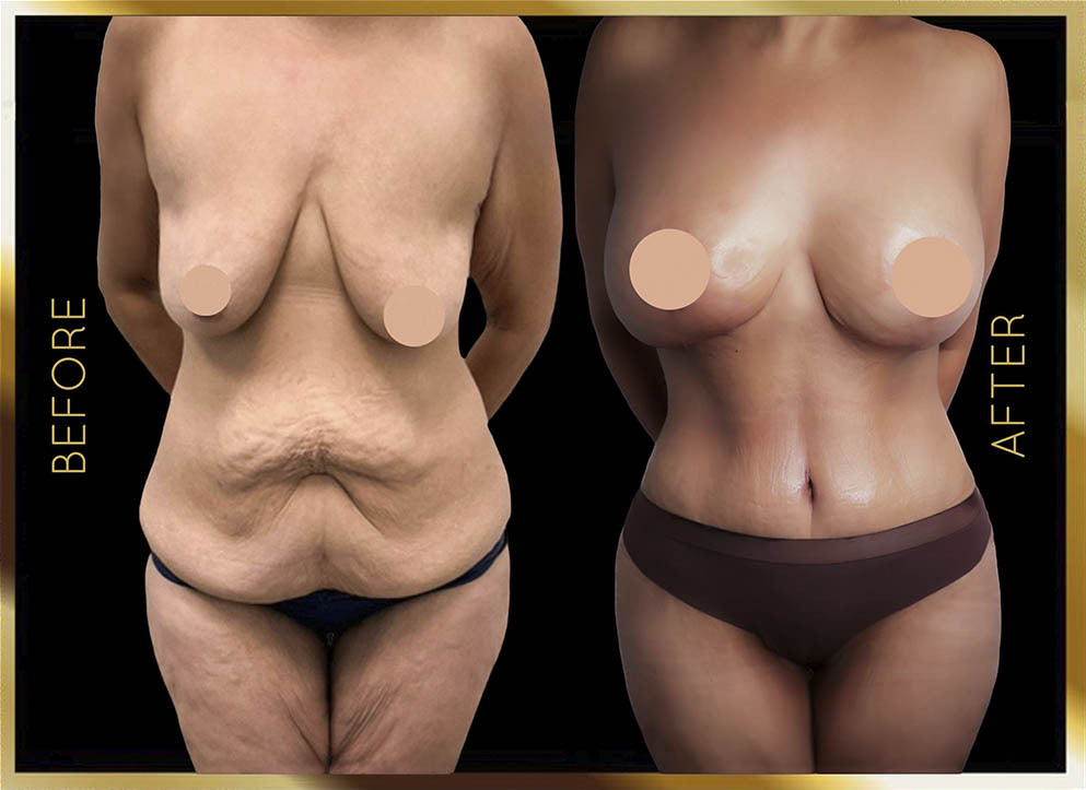 Extended Tummy Tuck Before and After NYC Case-6 Front