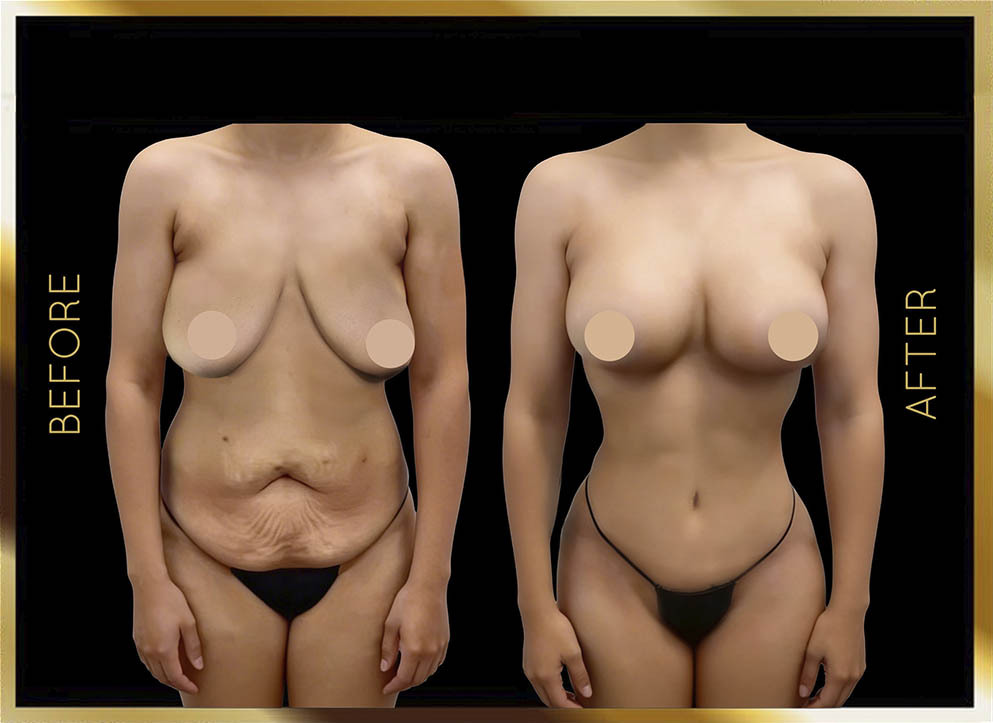 Extended Tummy Tuck Before and After NYC Case-7 Front
