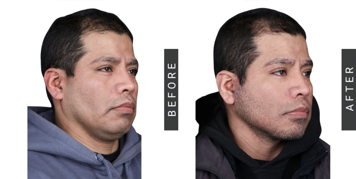 Facelift before and After