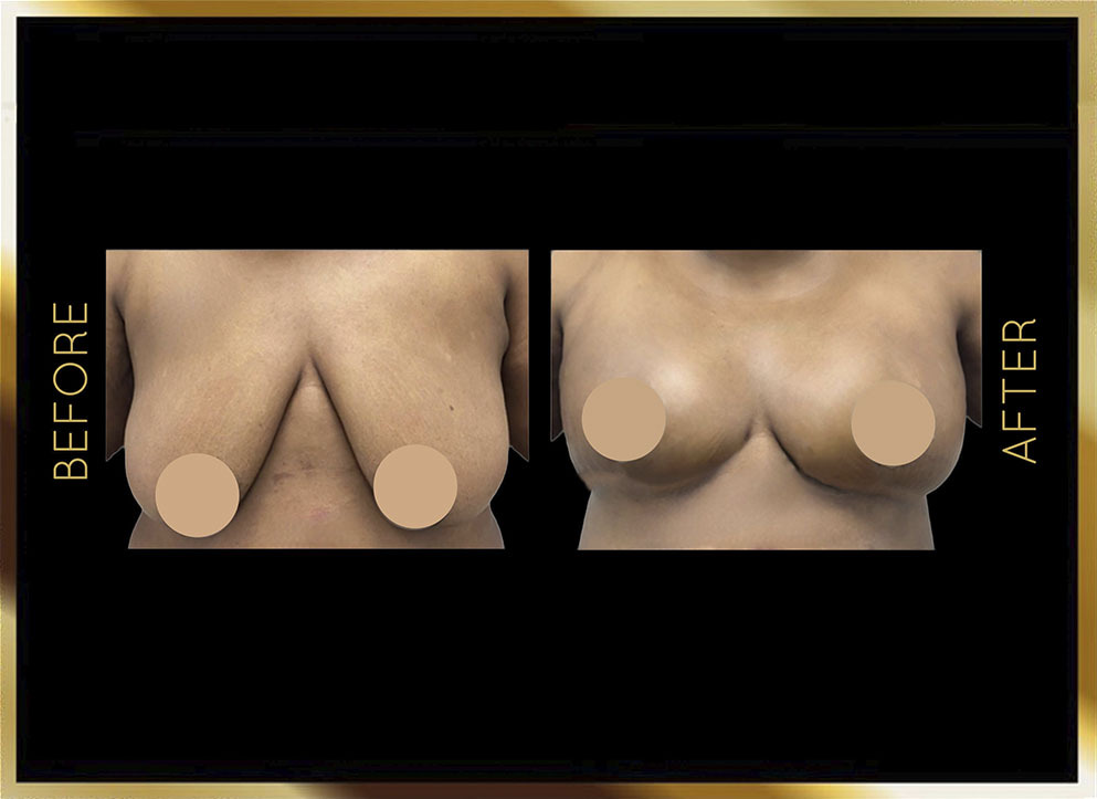 Aumento de pecho con transferencia de grasa: antes y después. Caso 1 en Nueva York: vista frontal