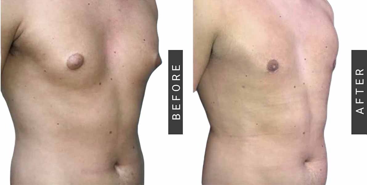 Gynecomastia Before and After