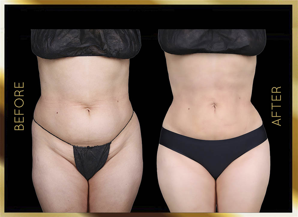 Hip Dip Surgery Before and After NYC Case-1 Front