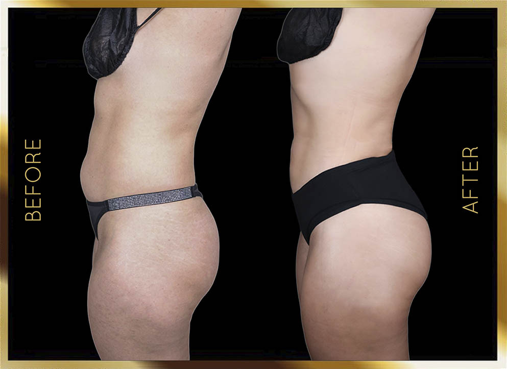 Hip Dip Surgery Before and After NYC Case-10 Side