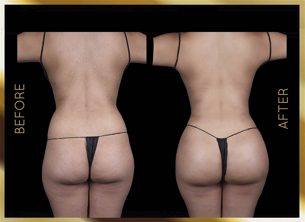 Hip Dip Surgery Before and After NYC Case-12 Front