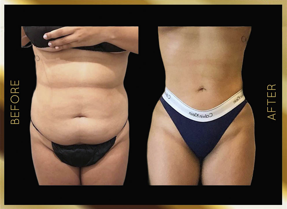 Cirugía de «hip dip»: antes y después. Nueva York, caso n.º 15, vista frontal