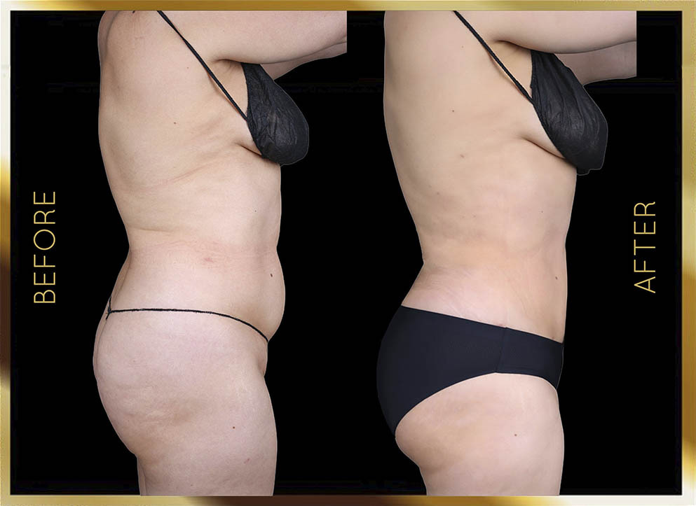 Hip Dip Surgery Before and After NYC Case-2 Side