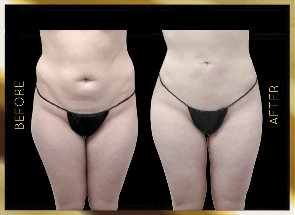 Hip Dip Surgery Before and After NYC Case-3 Front