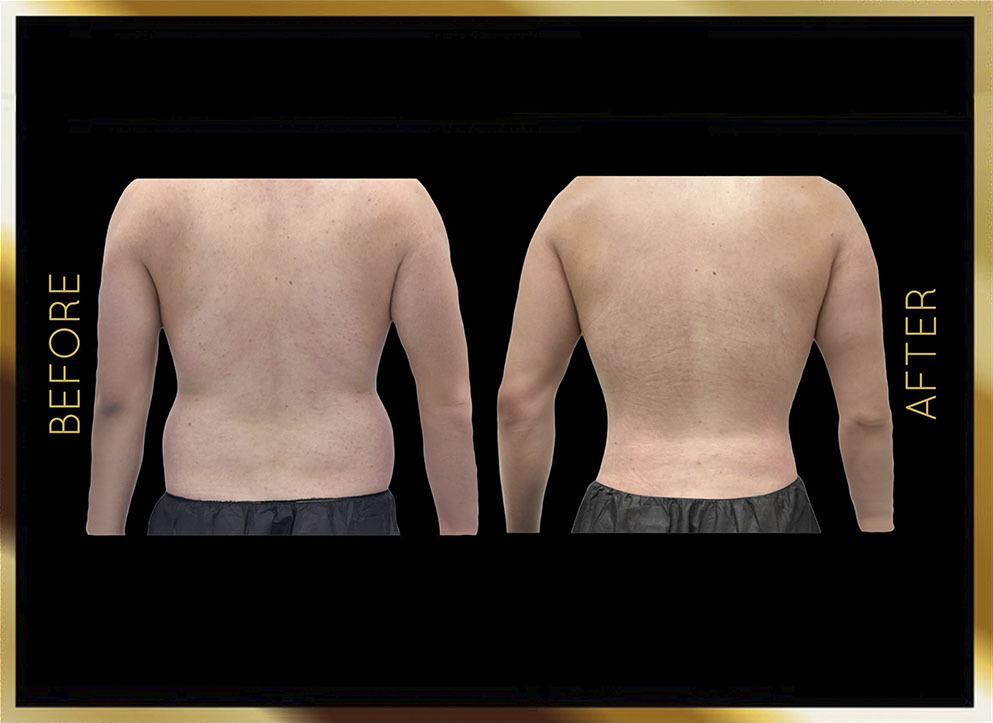 Hip Dip Surgery Before and After NYC Case-4 Front