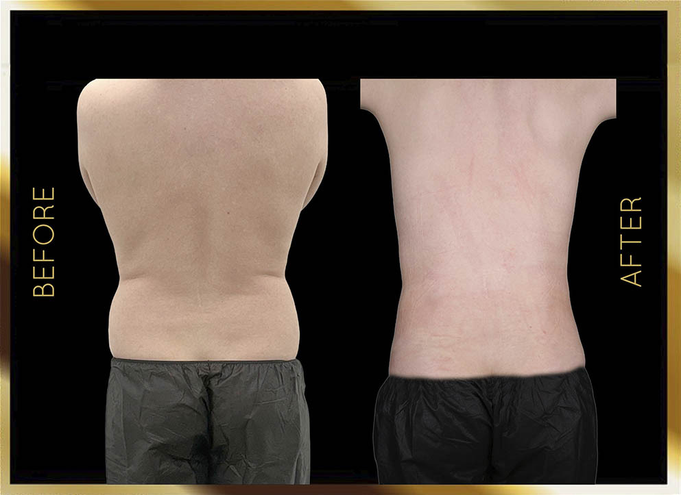 Hip Dip Surgery Before and After NYC Case-5 Front