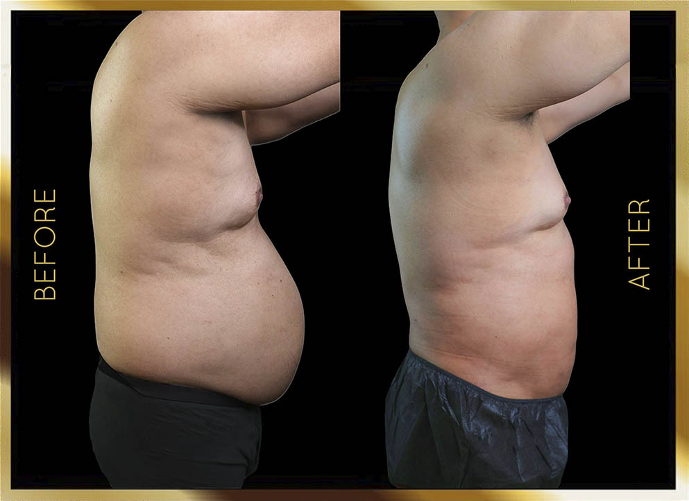 Hip Dip Surgery Before and After NYC Case-6 Side