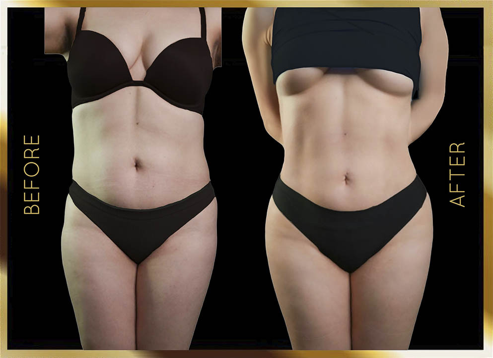 Hip Dip Surgery Before and After NYC Case-7 Front