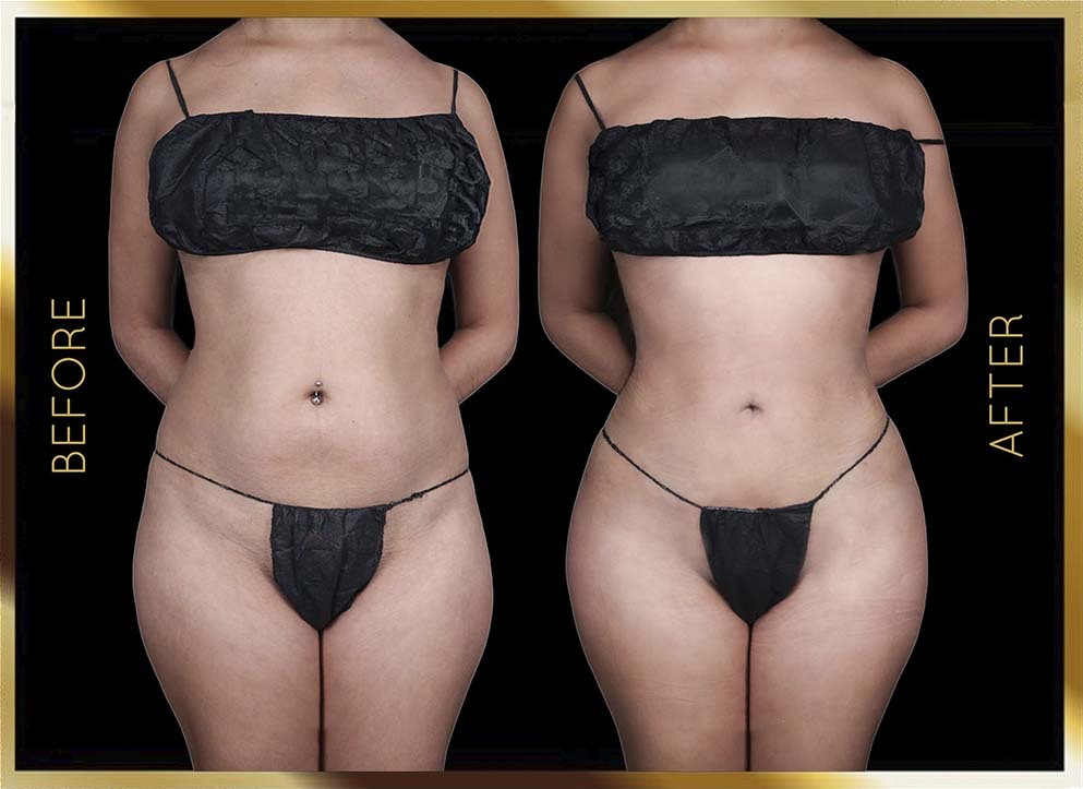 Hip Dip Surgery Before and After NYC Case-9 Front