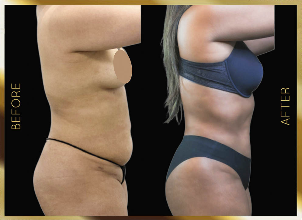 Liposucción de caderas: antes y después. Caso 1, Nueva York (vista lateral)