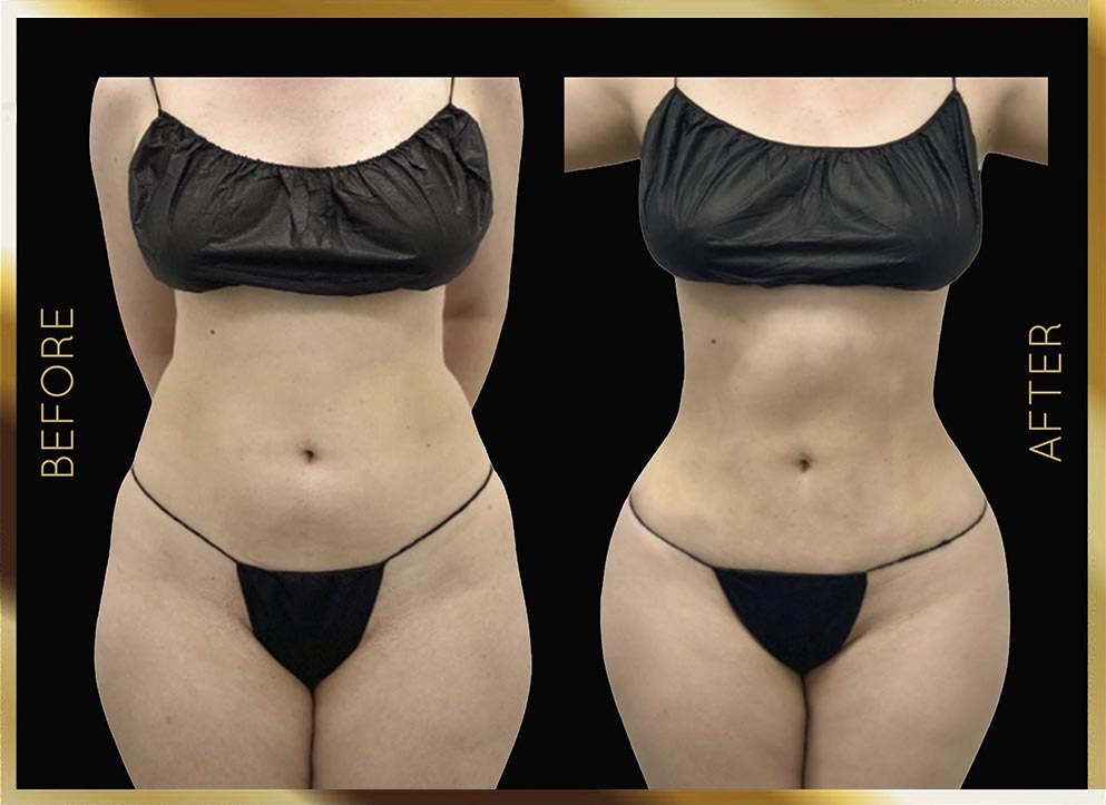 Liposucción de caderas: antes y después. Caso 2 en Nueva York: vista frontal