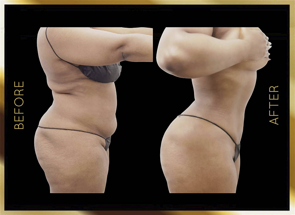 Liposucción: antes y después en Nueva York - Caso 11: perfil lateral