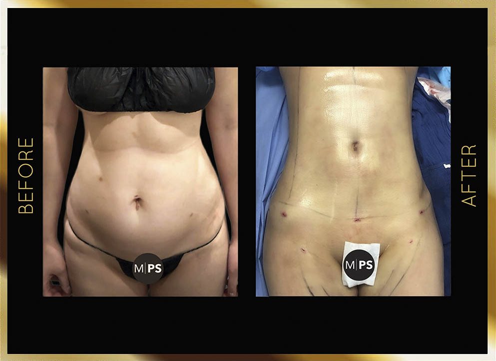 Liposuction Before and After NYC Case-13 Front