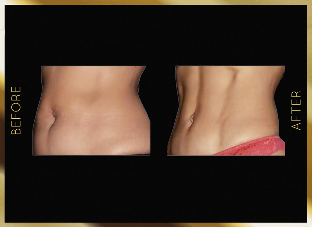 Liposuction Before and After NYC Case-14 Front