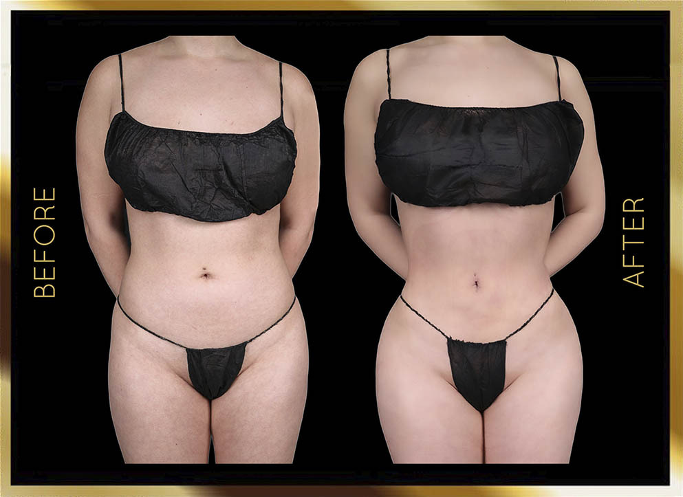 Liposucción: antes y después en Nueva York - Caso 8: vista frontal