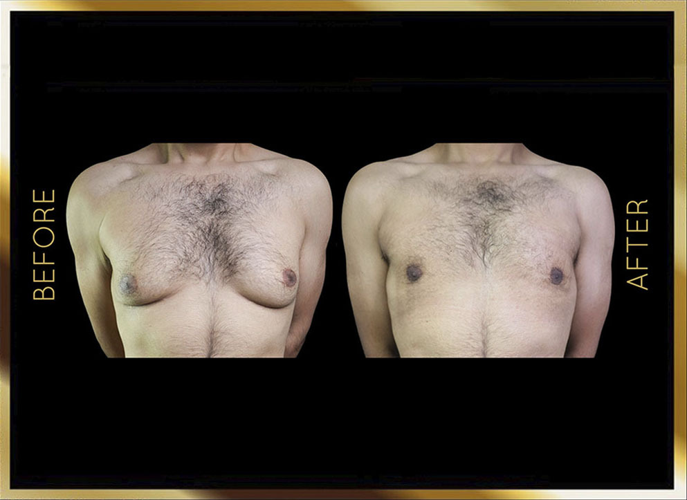 Male Gynecomastia Before and After NYC Case-1 Front