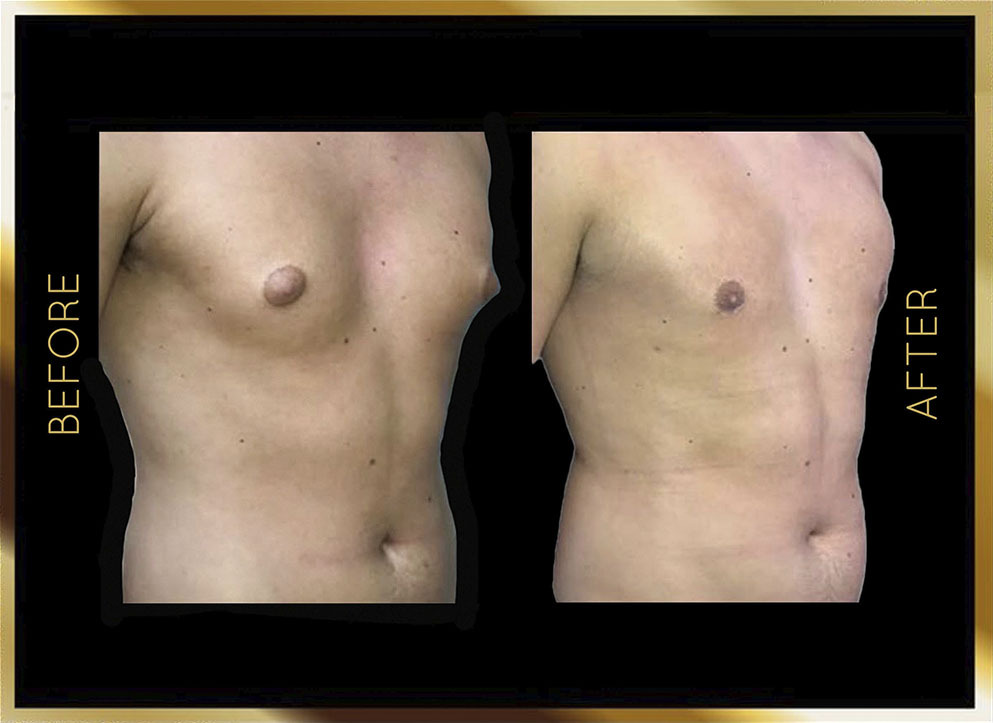 Male Gynecomastia Before and After NYC Case-2 Side