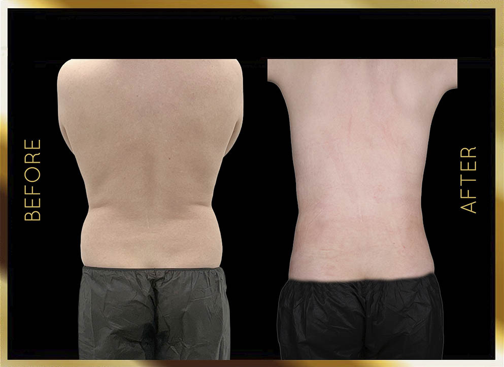 Liposucción masculina: antes y después. Nueva York. Caso 1