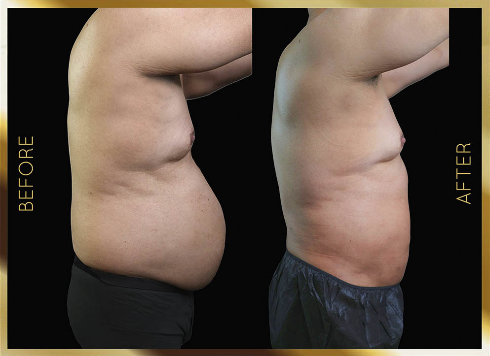Liposucción masculina: antes y después. Caso 2, Nueva York (vista lateral)