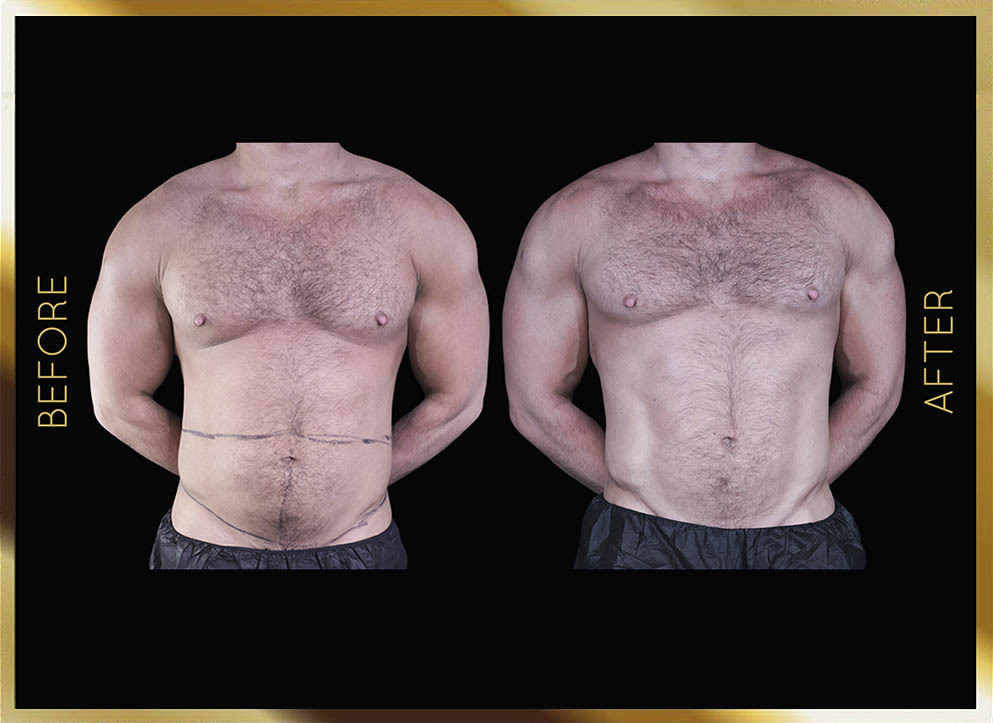 Liposucción masculina: antes y después. Nueva York. Caso 3