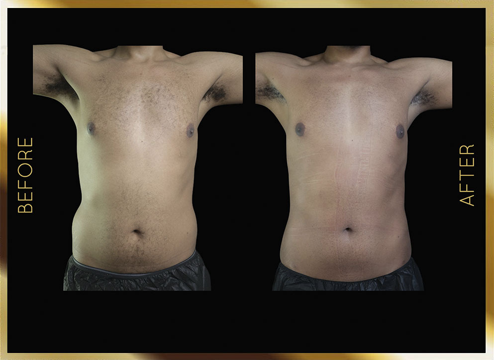 Liposucción masculina: antes y después en Nueva York - Caso 4