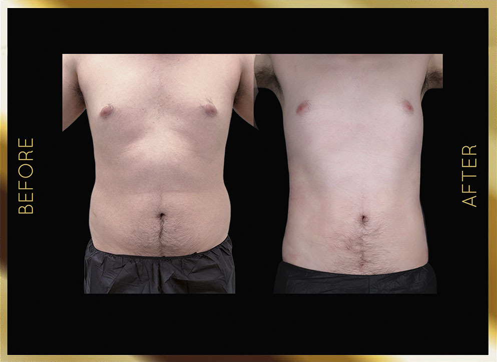Liposucción masculina: antes y después en Nueva York - Caso 5