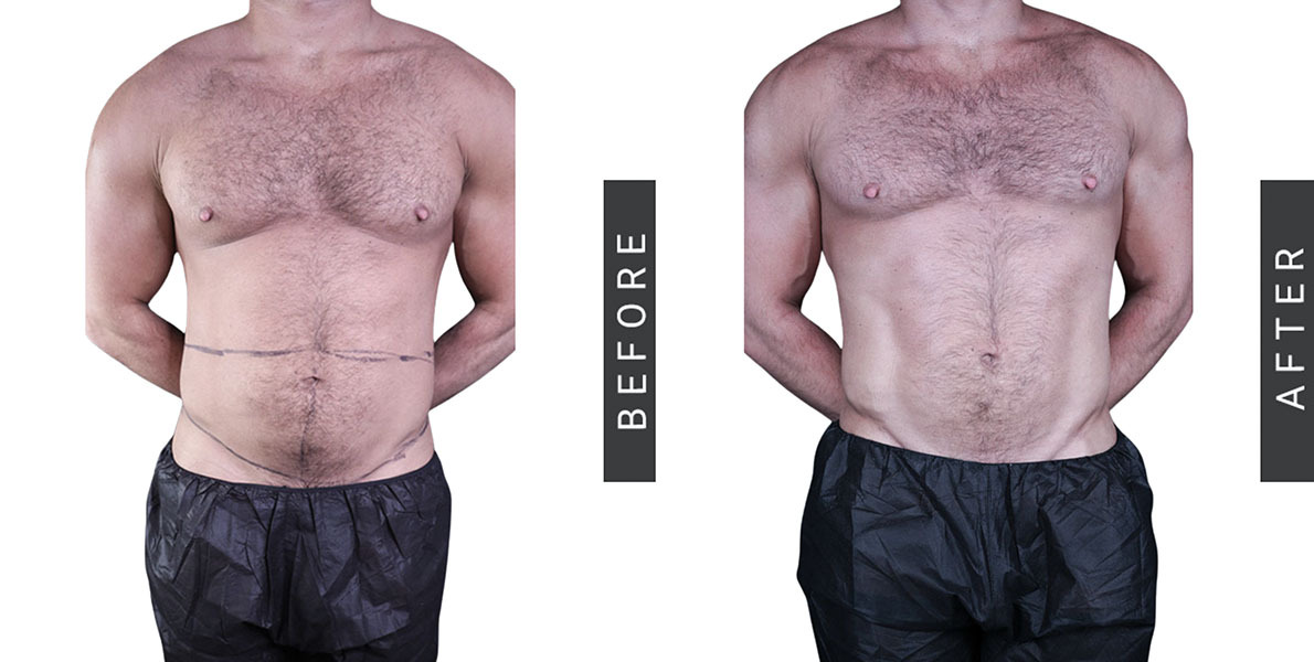 Male Liposuction Before & After