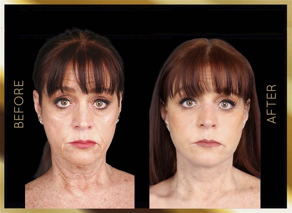 Mini Facelift Before After NYC Case-1 Front