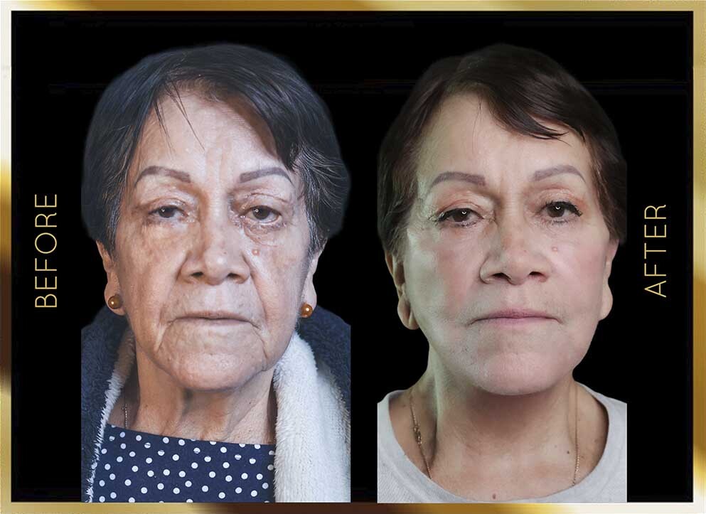 Mini Facelift Before After NYC Case-3 Front