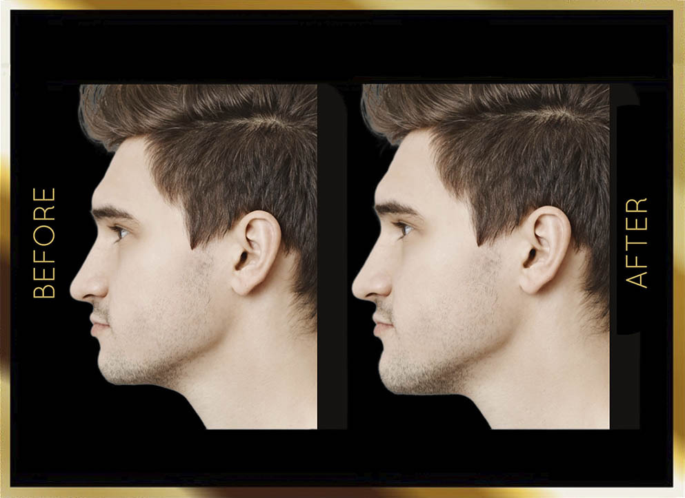 Mini Neck Lift Before and After NYC Case-1