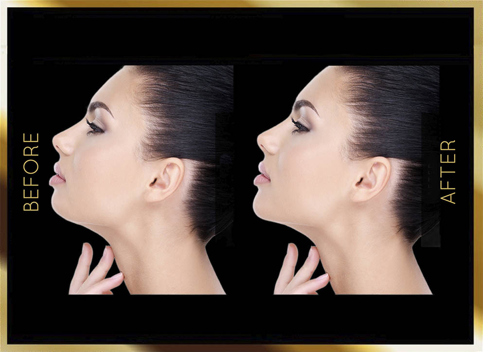 Mini Neck Lift Before and After NYC Case-2