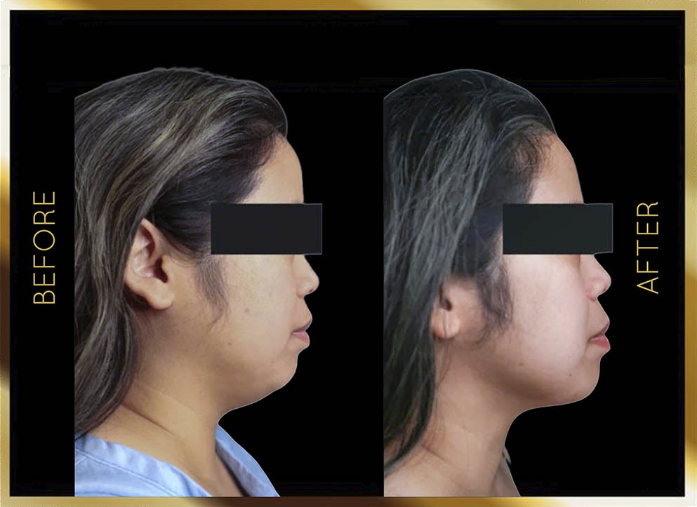 Mini Neck Lift Before and After NYC Case-3