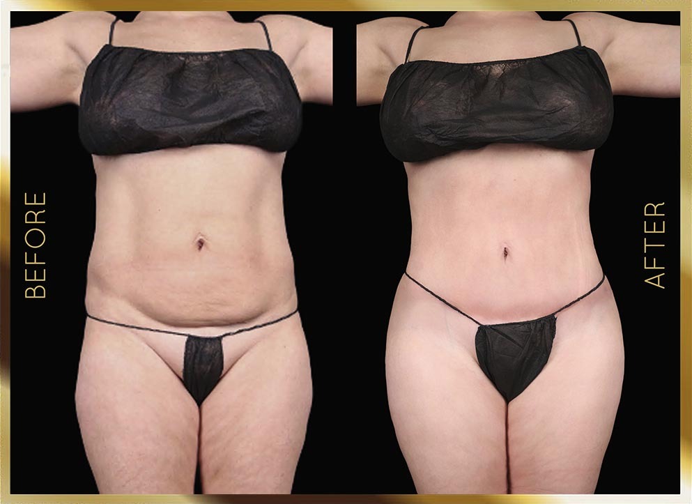 Mini Tummy Tuck Before & After NYC Case-1