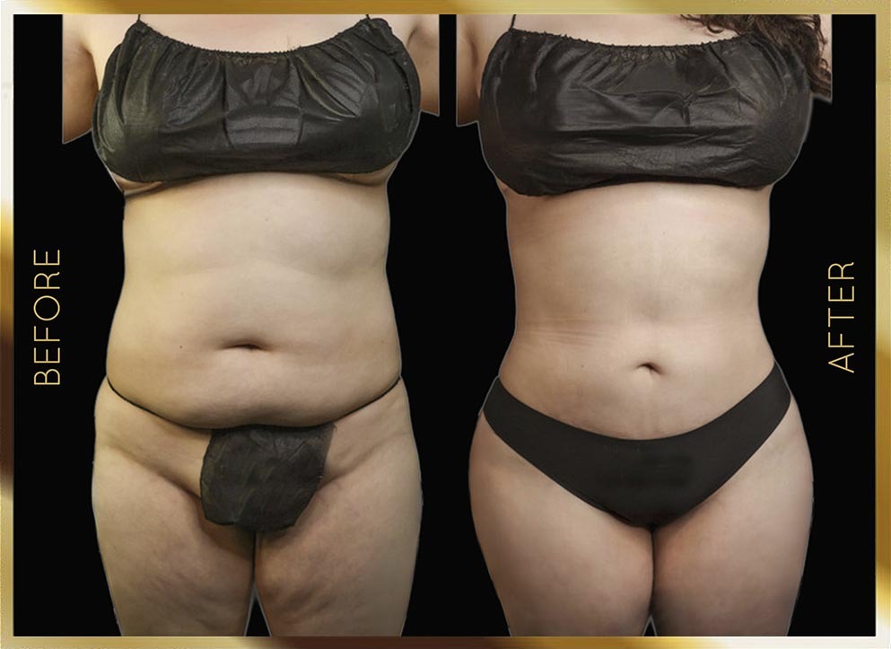 Mini Tummy Tuck Before & After NYC Case-2