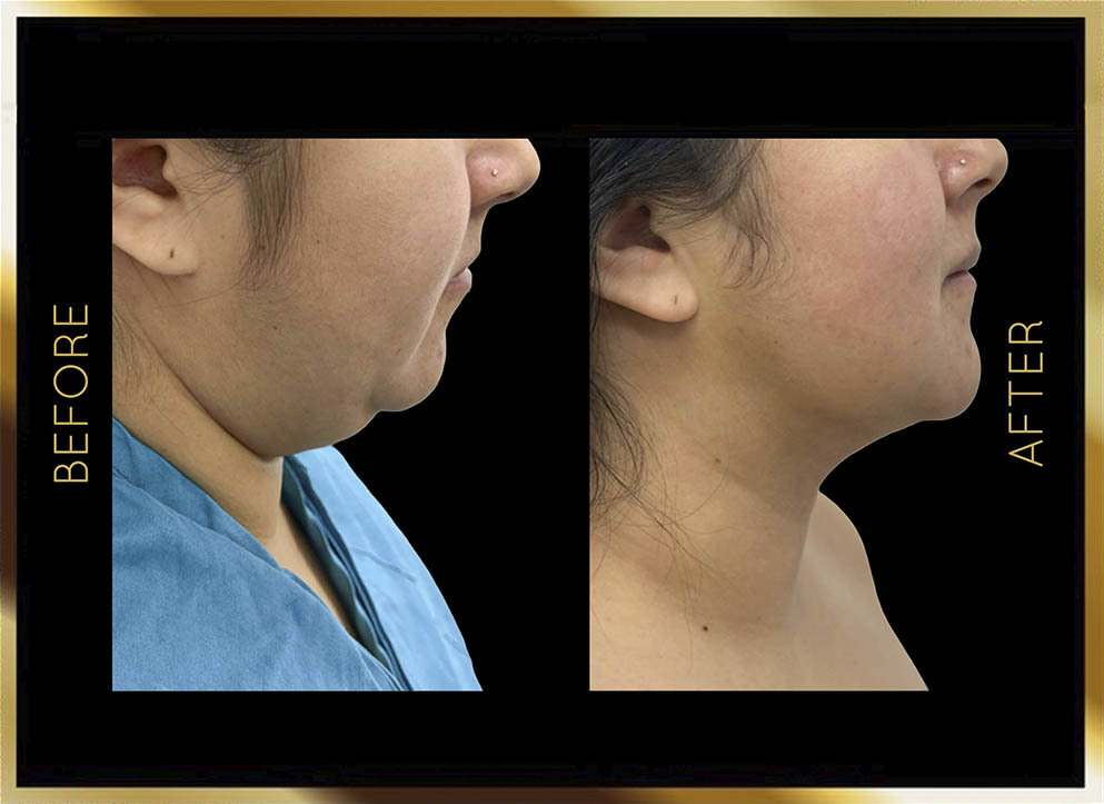 Lifting de cuello: antes y después. Caso n.º 5 en Nueva York