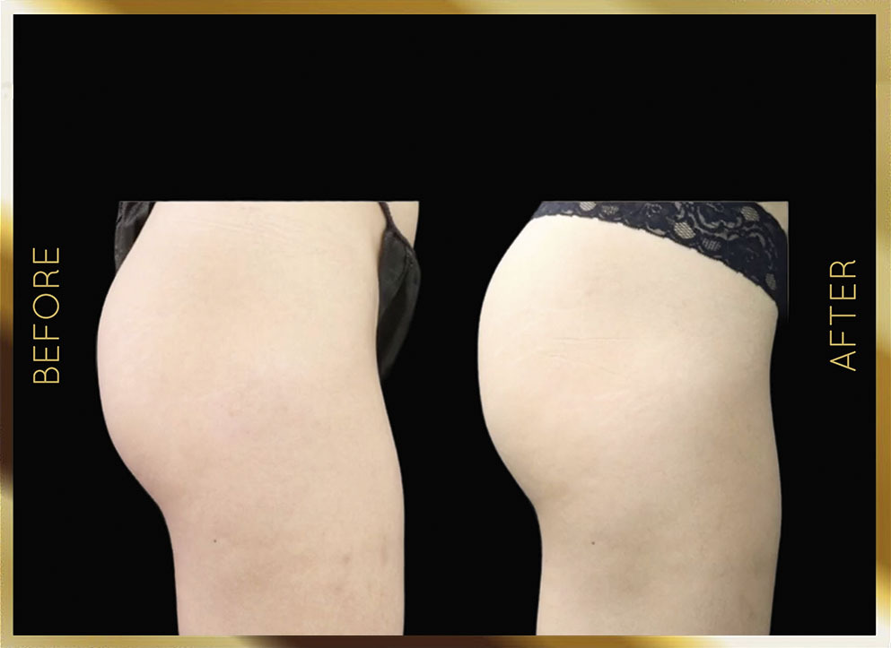 Non Surgical BBL Before & After NYC Case-1

