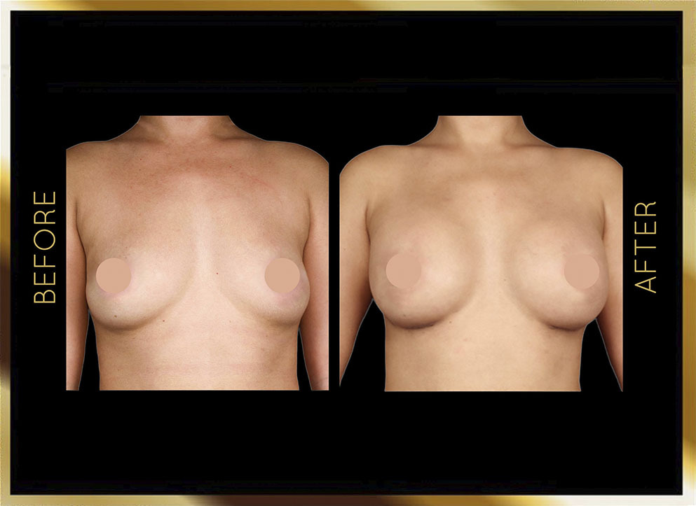Implantes mamarios de silicona y solución salina: antes y después. Caso 2, Nueva York. Vista frontal