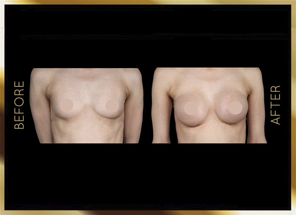 Implantes mamarios de silicona y solución salina: antes y después. Caso 4, Nueva York. Vista frontal