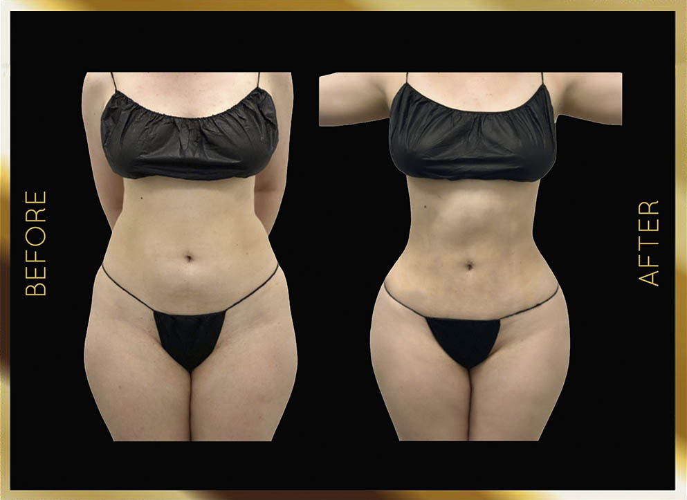 Thighs Liposuction Before & After NYC Case-2