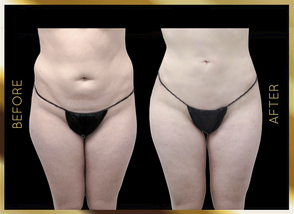 Thighs Liposuction Before & After NYC Case-3