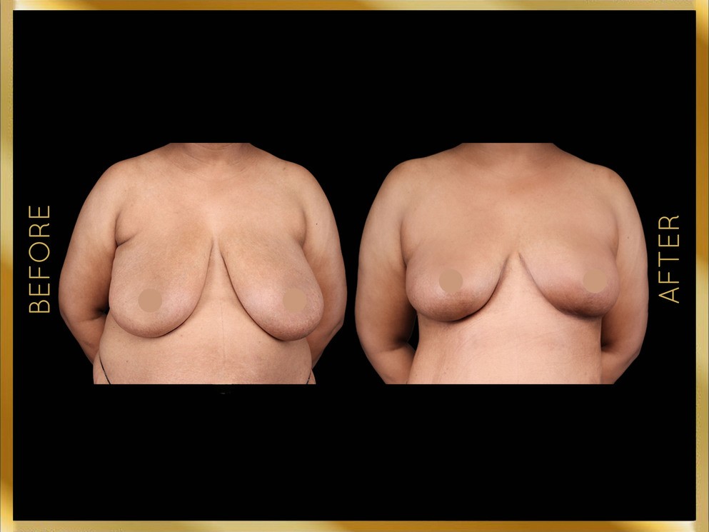 Breast Reduction Before and After NYC