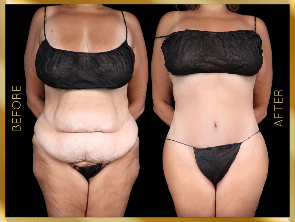 Mommy Makeover Before & After NYC