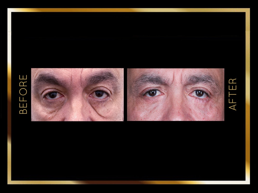 Blefaroplastia: antes y después en Nueva York - Caso 1