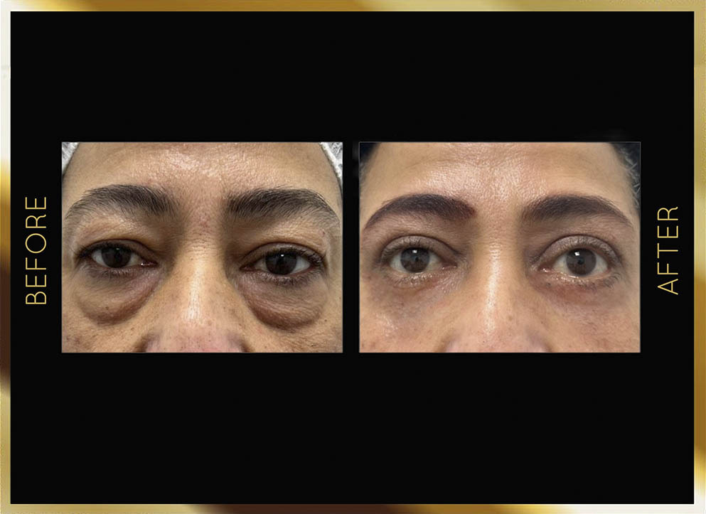 Blefaroplastia: antes y después en Nueva York - Caso 2