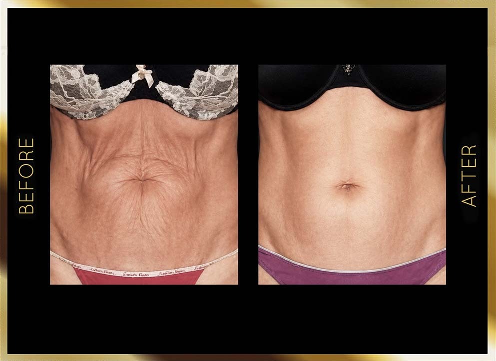 Evolve Before & After NYC Case-2