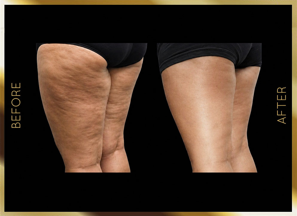 Evolve Before & After NYC Case-4