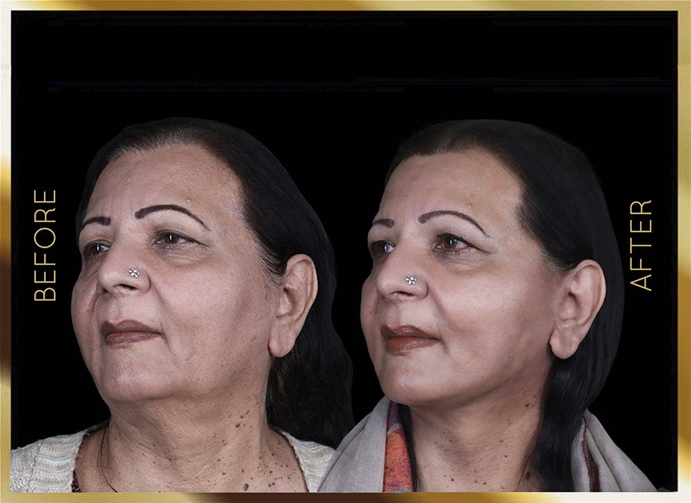 Facelift Before and After NYC Case-2 Side